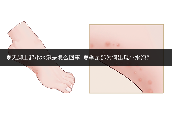 夏天腳上起小水泡是怎么回事 夏季足部為何出現小水泡？