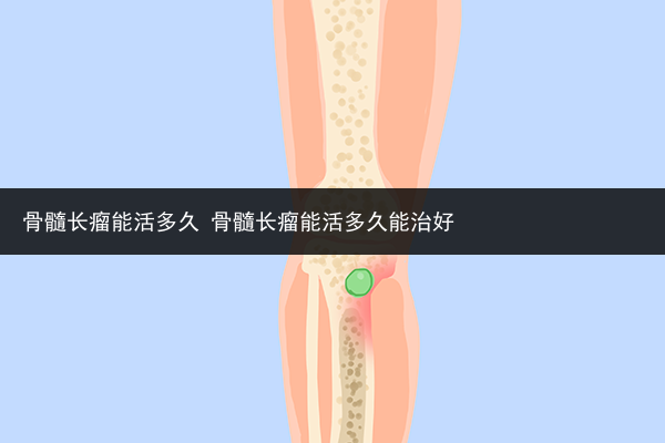 骨髓長瘤能活多久 骨髓長瘤能活多久能治好