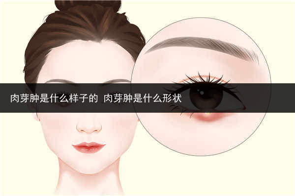 肉芽腫是什么樣子的 肉芽腫是什么形狀