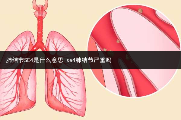 肺結節SE4是什么意思 se4肺結節嚴重嗎