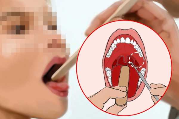 急性扁桃體炎怎么辦 急性扁桃體炎怎么辦最快最有效
